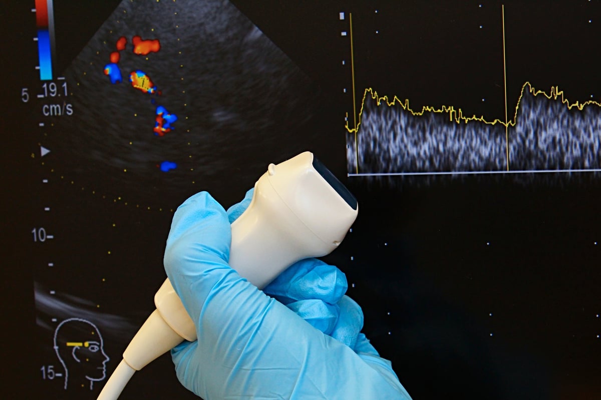 Modern transcranial Doppler ultrasound probe held by doctor in blue glove for neurological examination