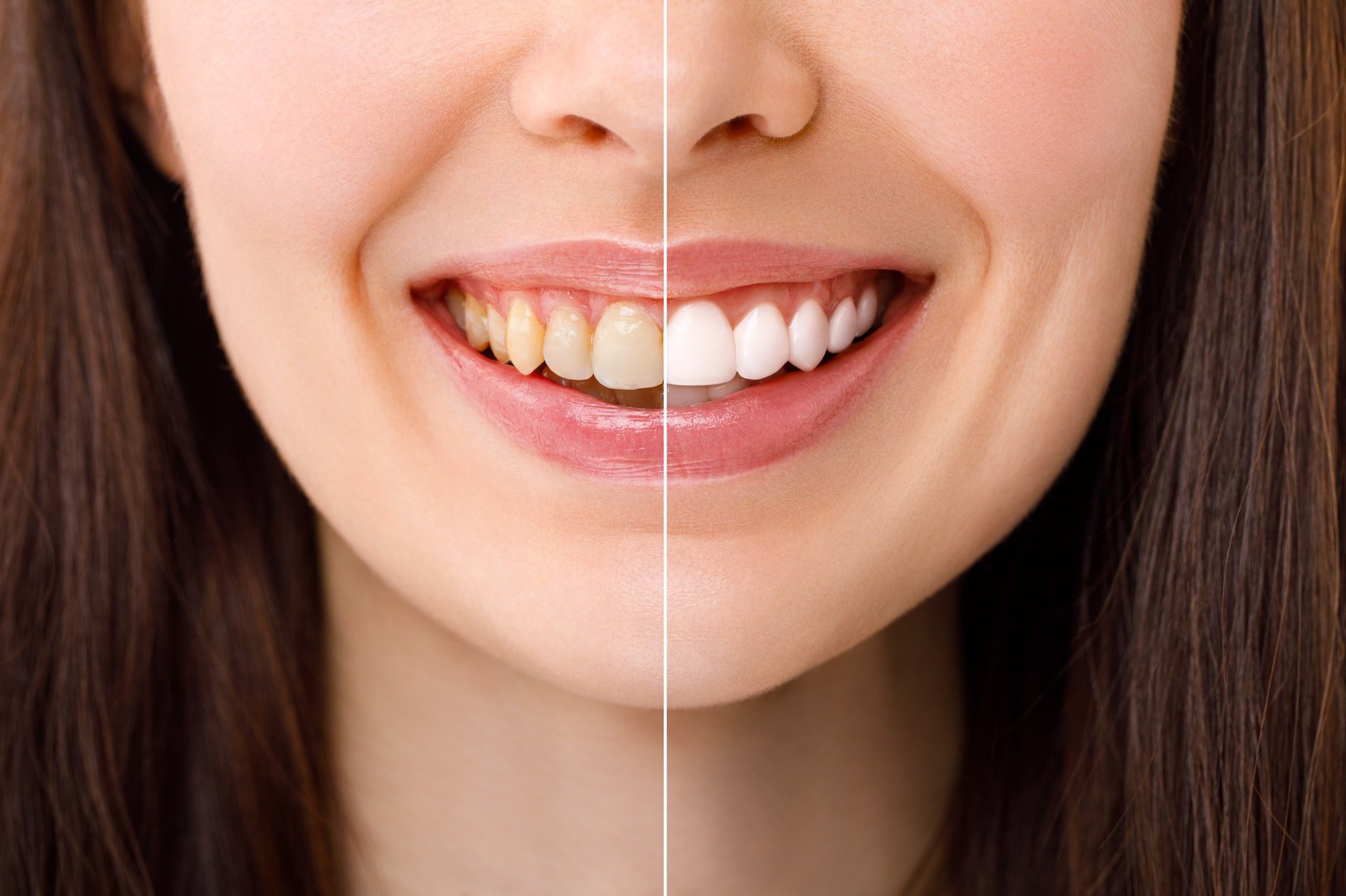 Smiling woman before and after a professional teeth whitening procedure, bright white smile
