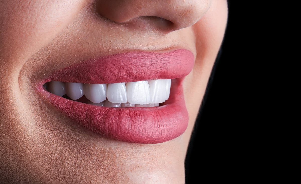 Close-up of beautiful natural-looking porcelain veneer teeth in a smile