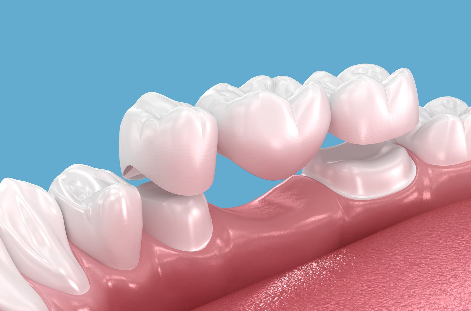 3D illustration of a fixed dental bridge replacing missing teeth