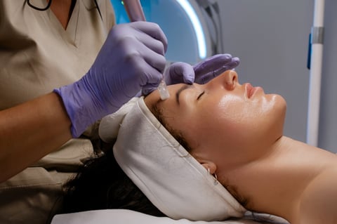 Microneedling treatment — skin rejuvenation