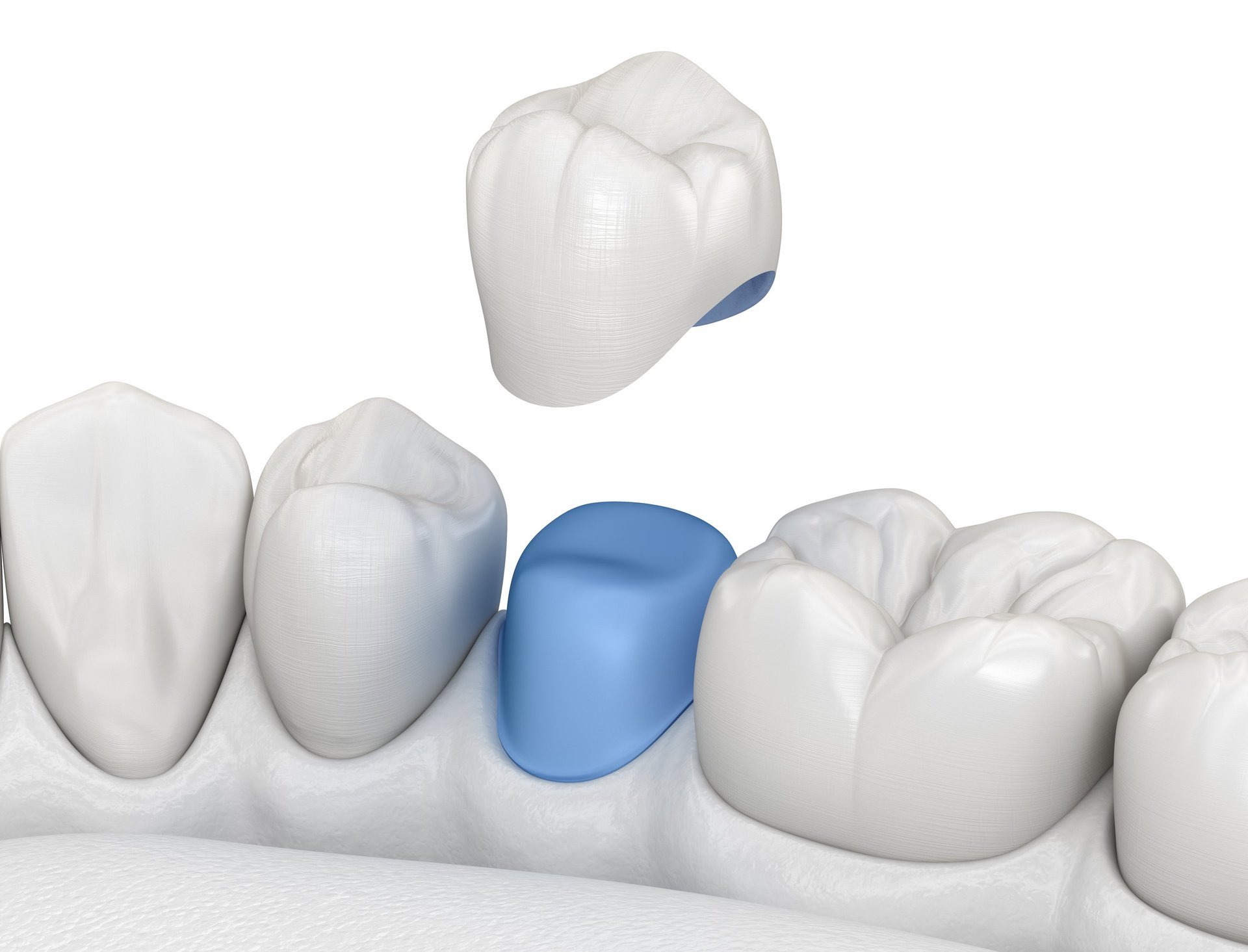 3D illustration of a porcelain dental crown being placed over a tooth