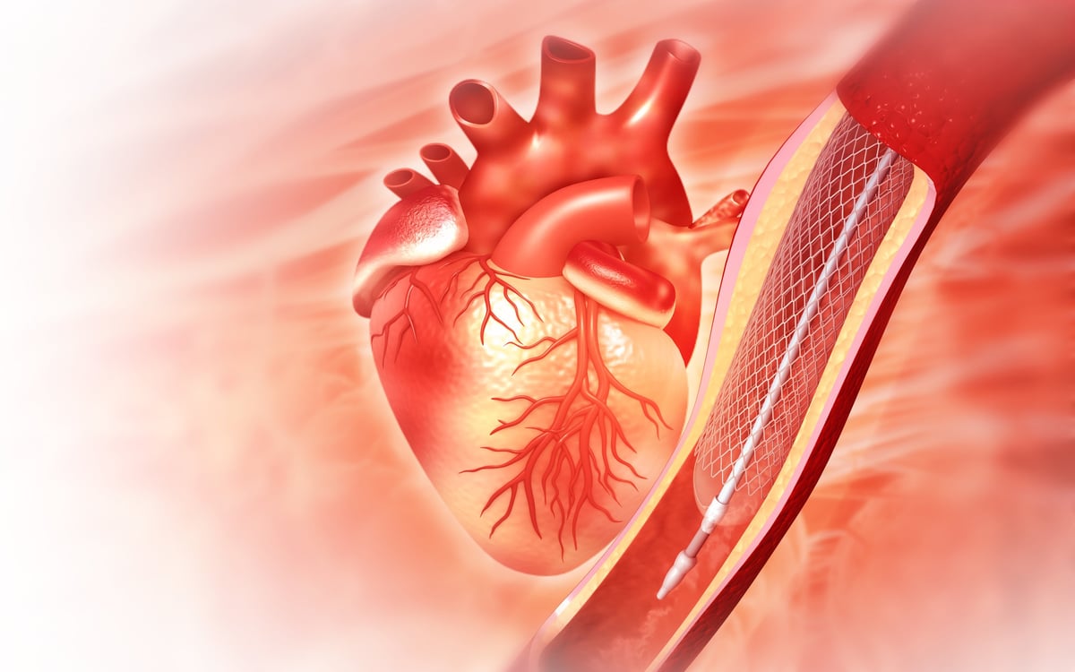 Ilustración del corazón con un stent colocado en una arteria