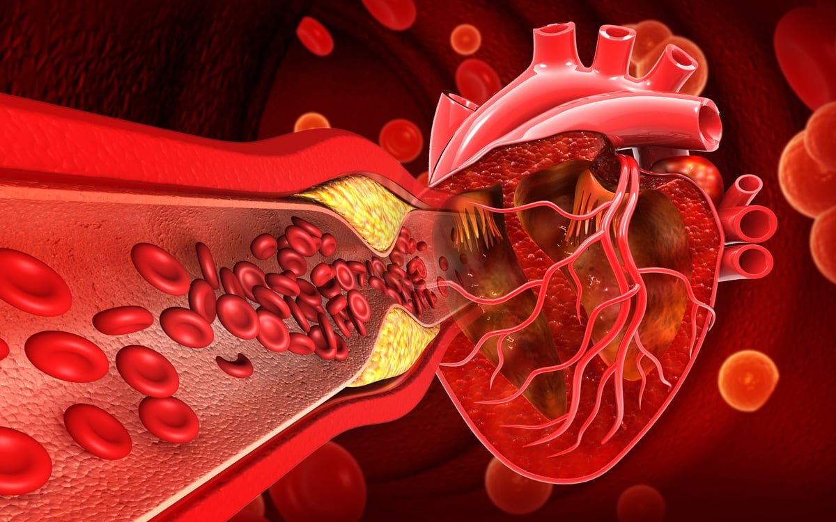 Ilustración anatómica del corazón con un vaso sanguíneo obstruido