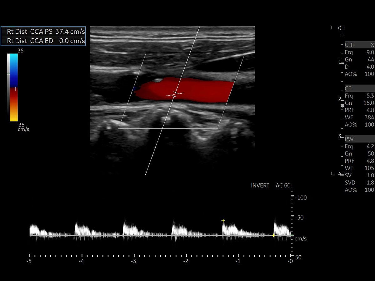 Color Doppler ultrasound study of carotid artery showing blood flow analysis