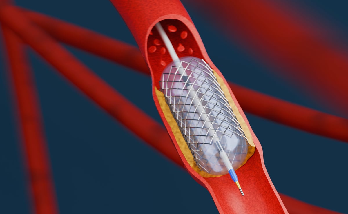 Ilustración de angioplastia con balón y colocación de stent en una arteria coronaria
