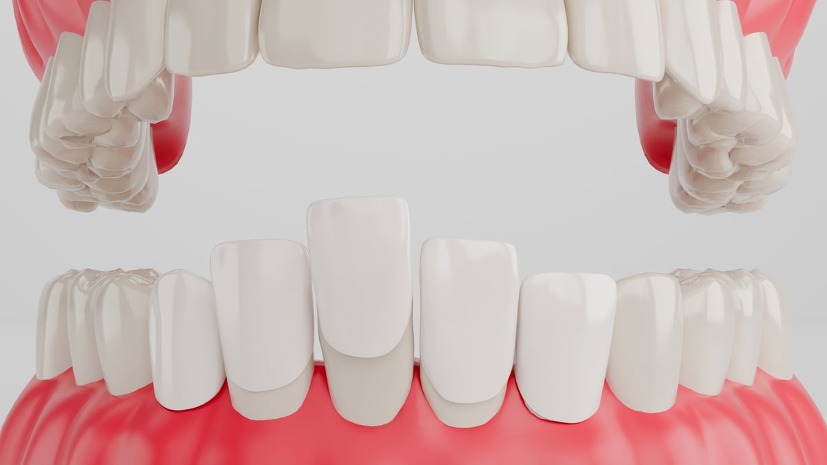 3D illustration of cosmetic dental veneers being applied to front teeth