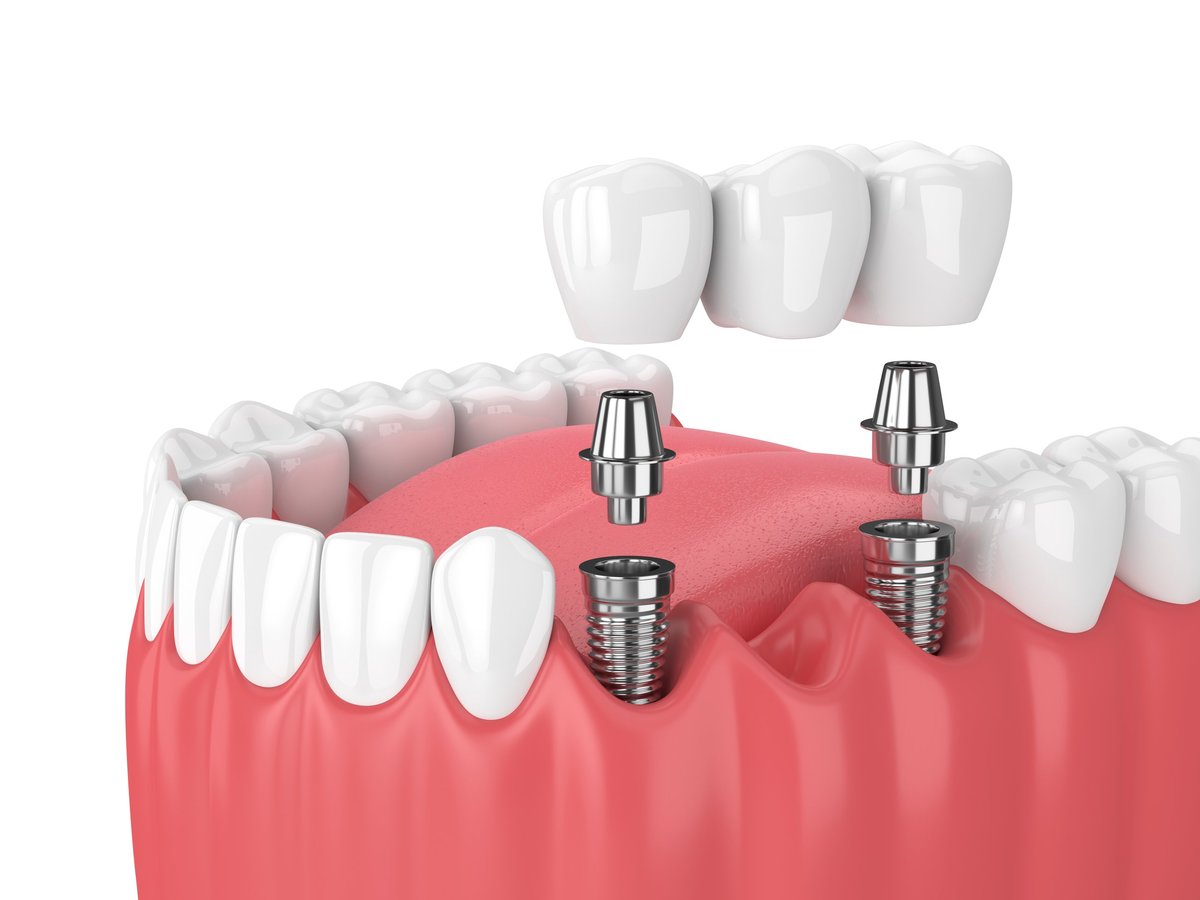 3D rendering of a jaw with dental implants supporting a bridge