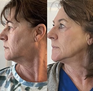 Before and after comparison of body treatment
