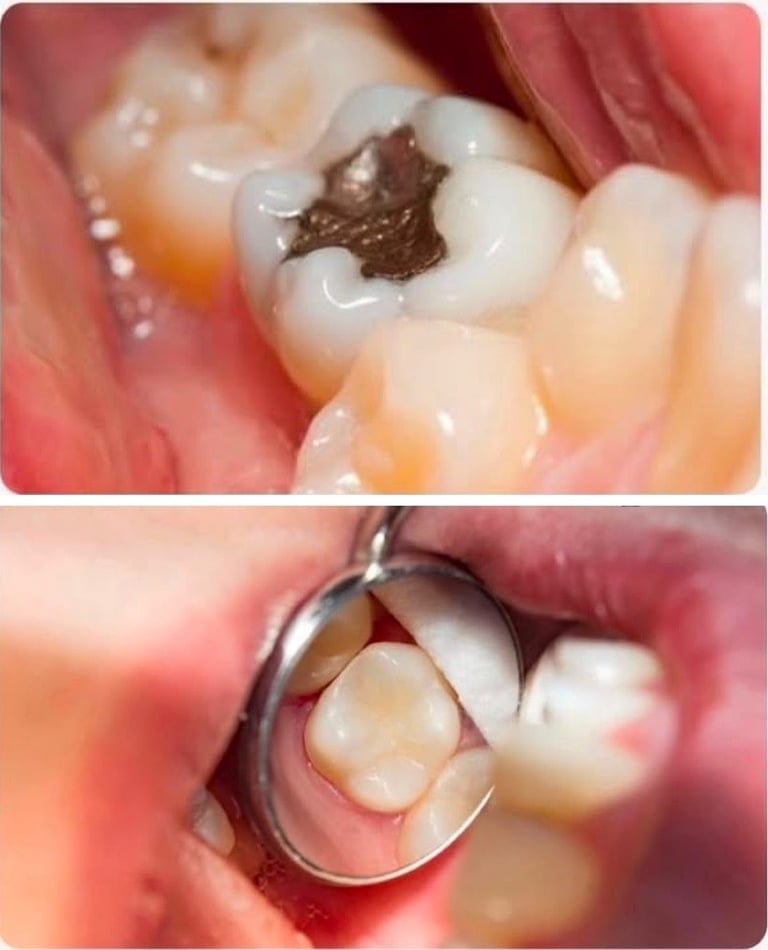 Restauración de molar, cambio de amalgama por resina, antes y después, Dr. Elías Sánchez, Zapopan