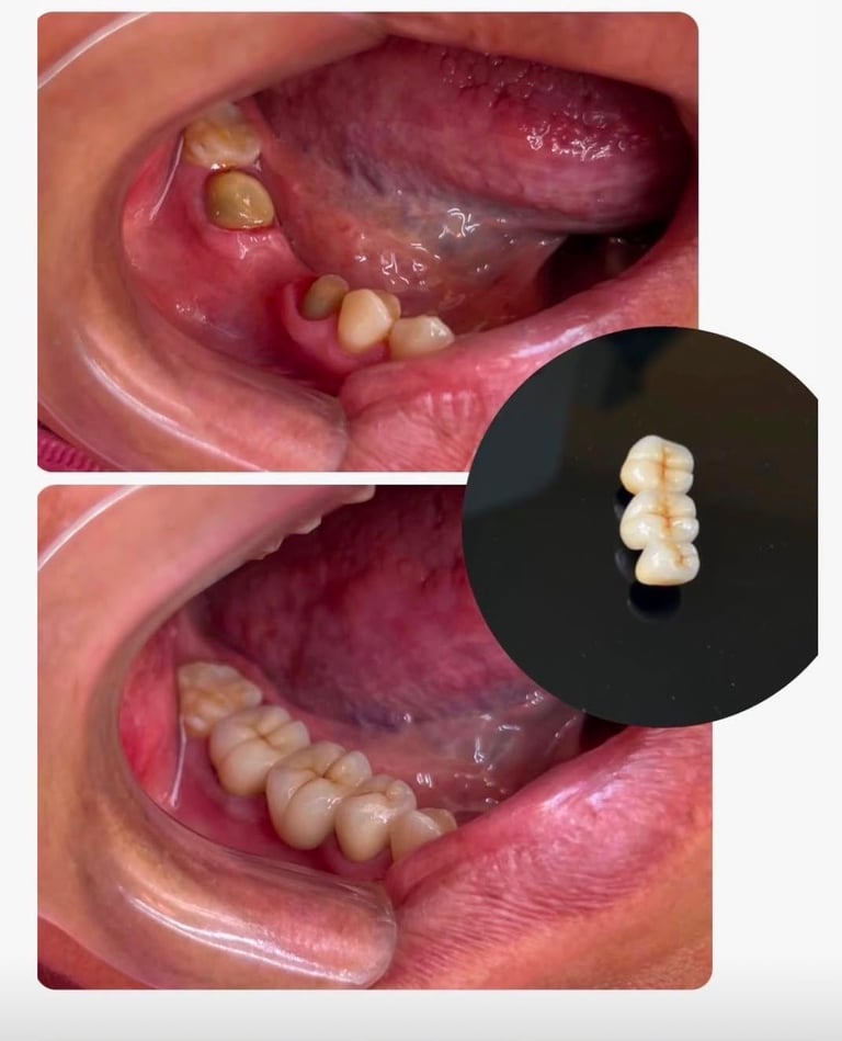 Corona dental sobre molar, antes y después, Dr. Elías Sánchez, Zapopan