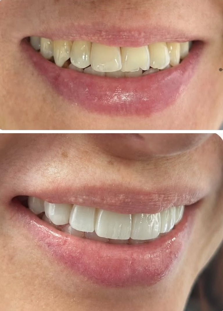Carillas dentales antes y después, cambio de sonrisa, Dr. Elías Sánchez, Zapopan