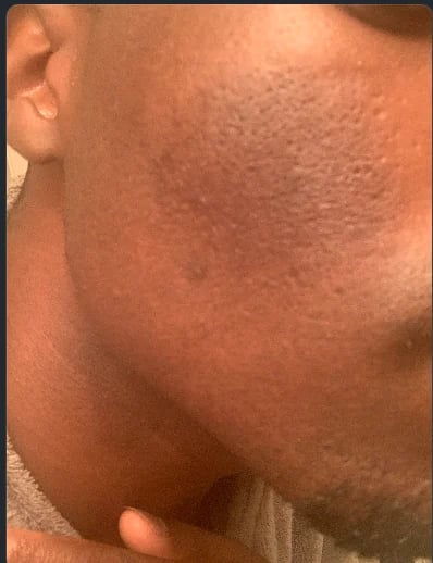 Close-up documentation of active skin inflammation and acne scarring on face and neck