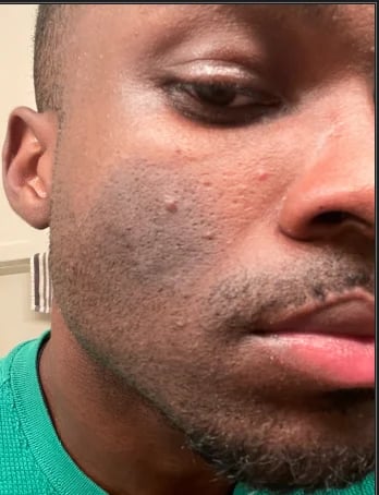 Close-up side profile during active inflammation stage