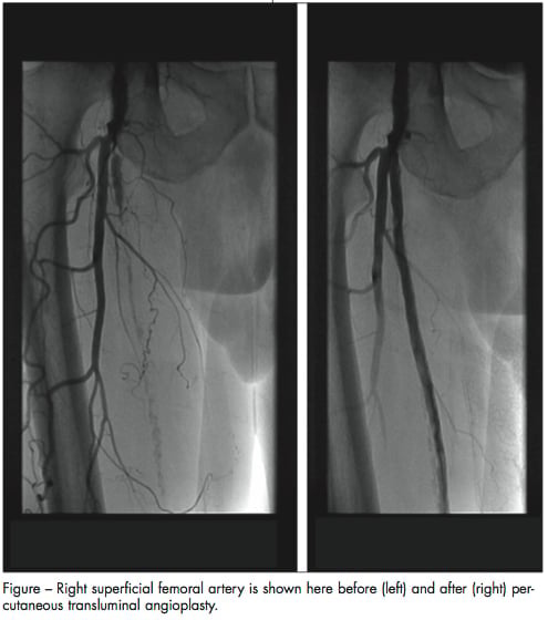 Comparison X-rays of right superficial femoral artery before and after percutaneous transluminal angioplasty procedure
