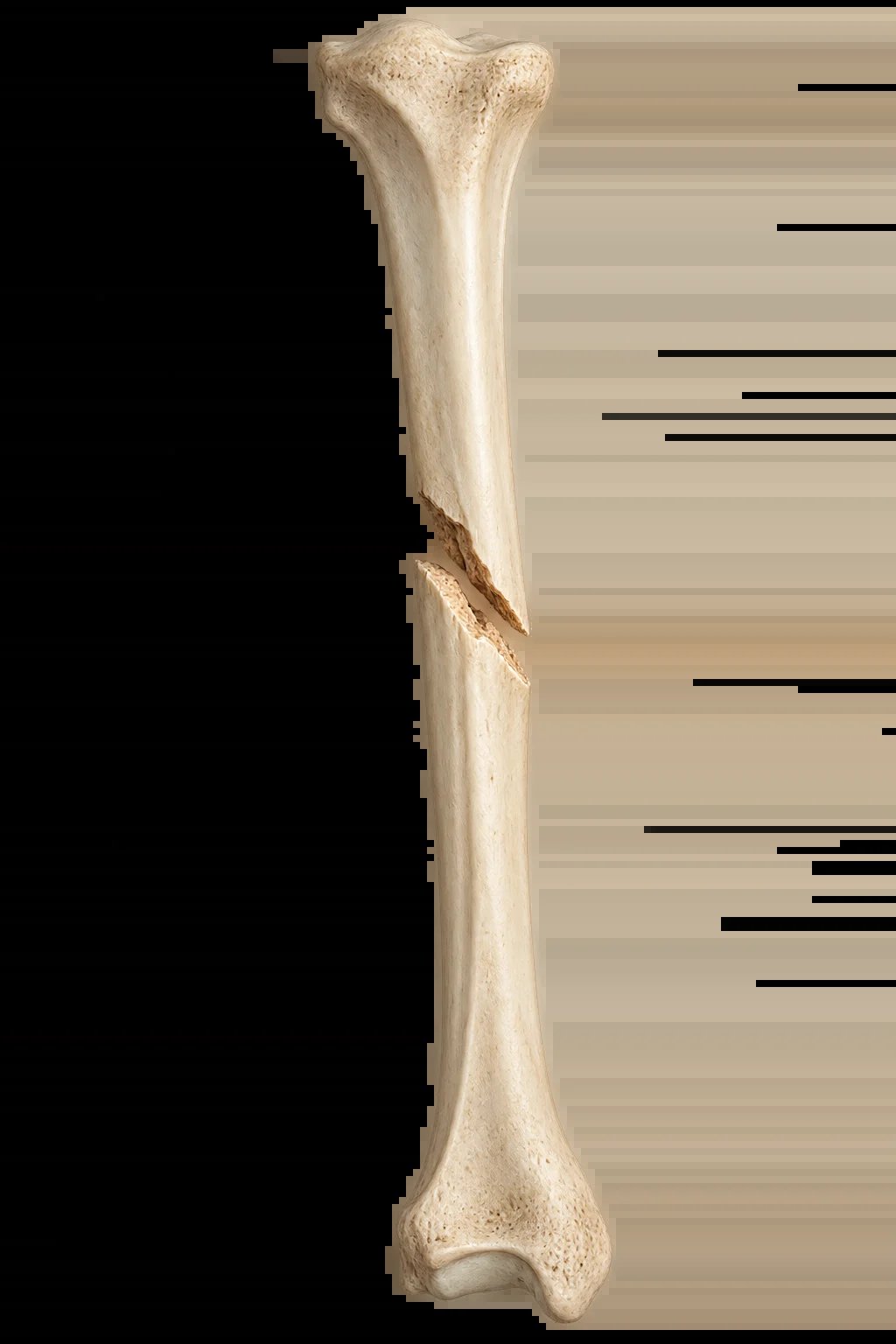 Human tibia bone showing fracture line across the shaft, displayed against black background
