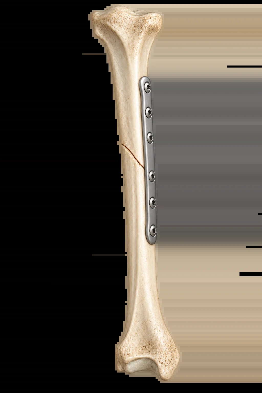Femur bone with surgical metal plate and screws secured along the shaft against a black background