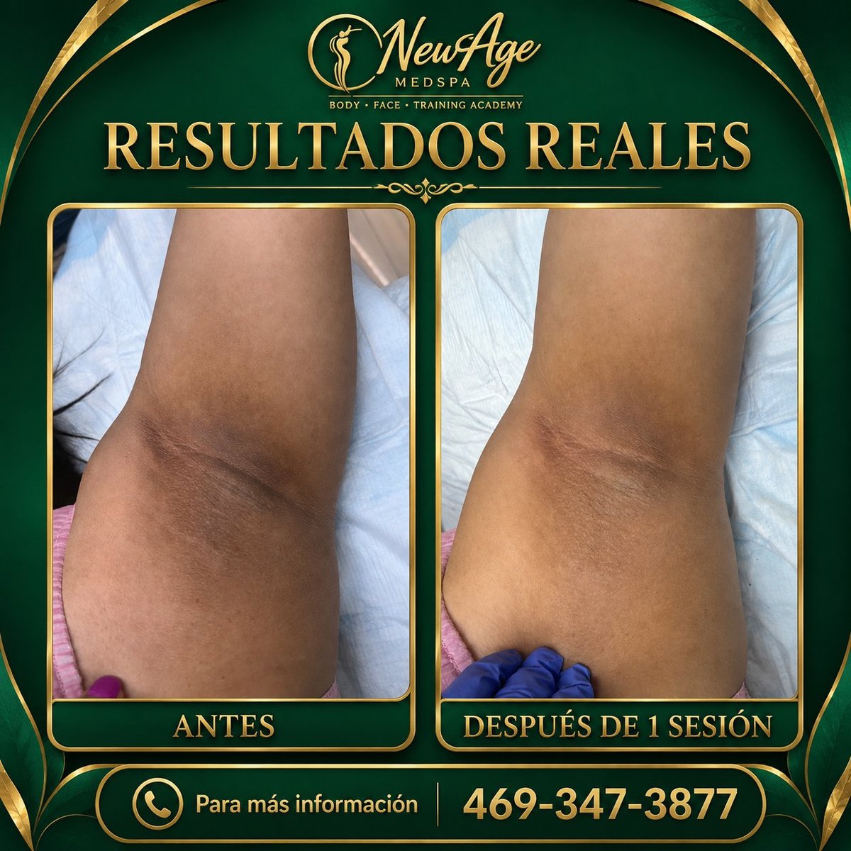 Antes y después: Tratamiento corporal