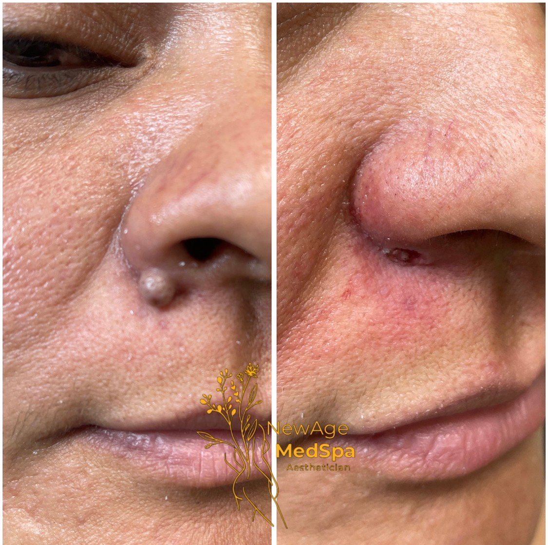 Antes y después: Rejuvenecimiento facial