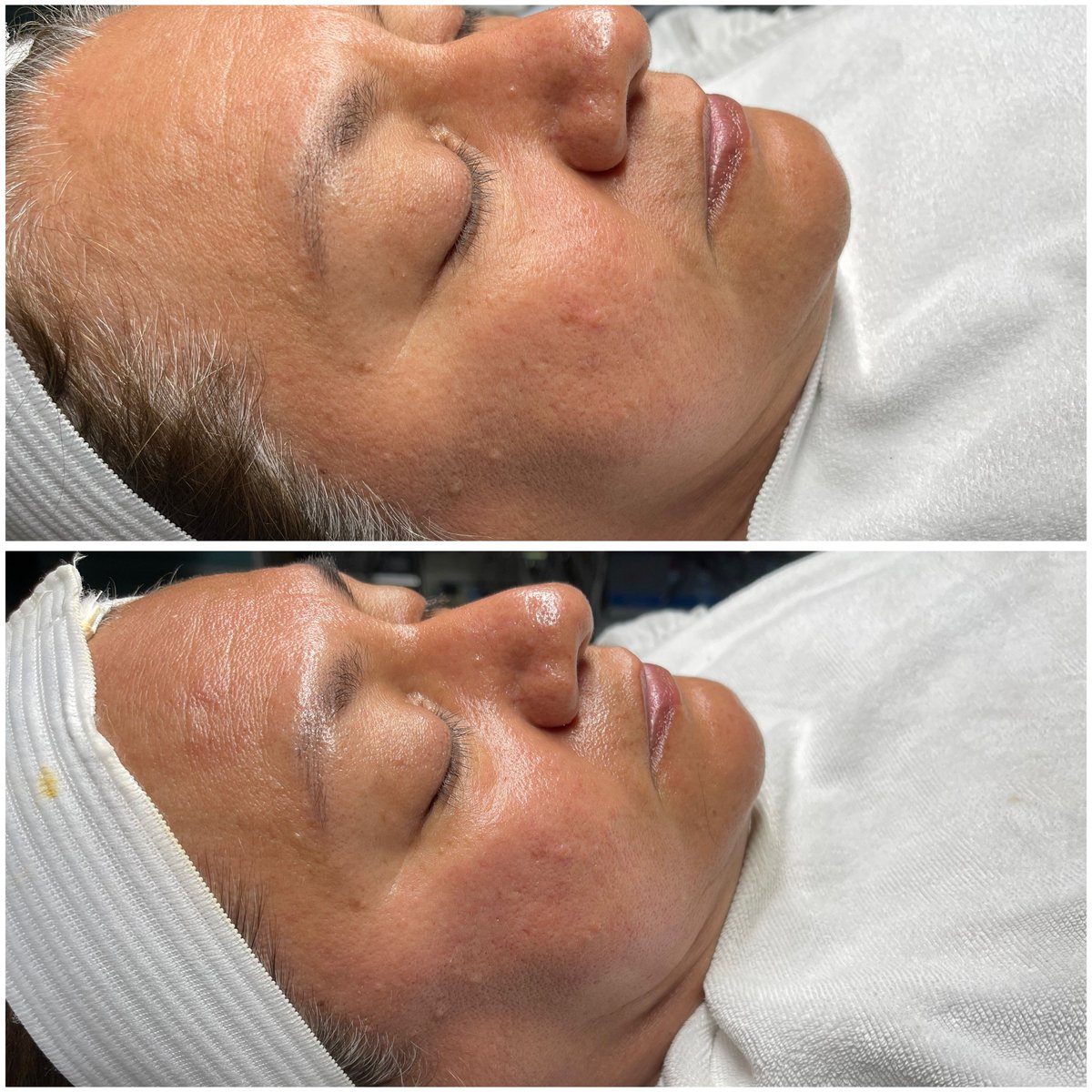 Antes y después: Tratamiento facial