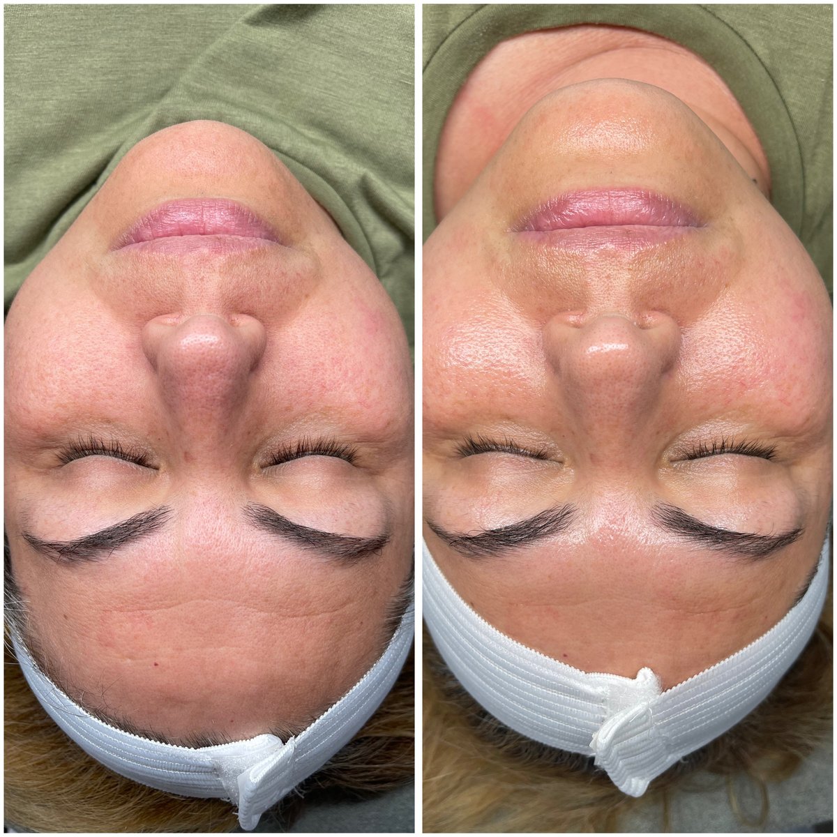 Antes y después: Rejuvenecimiento facial