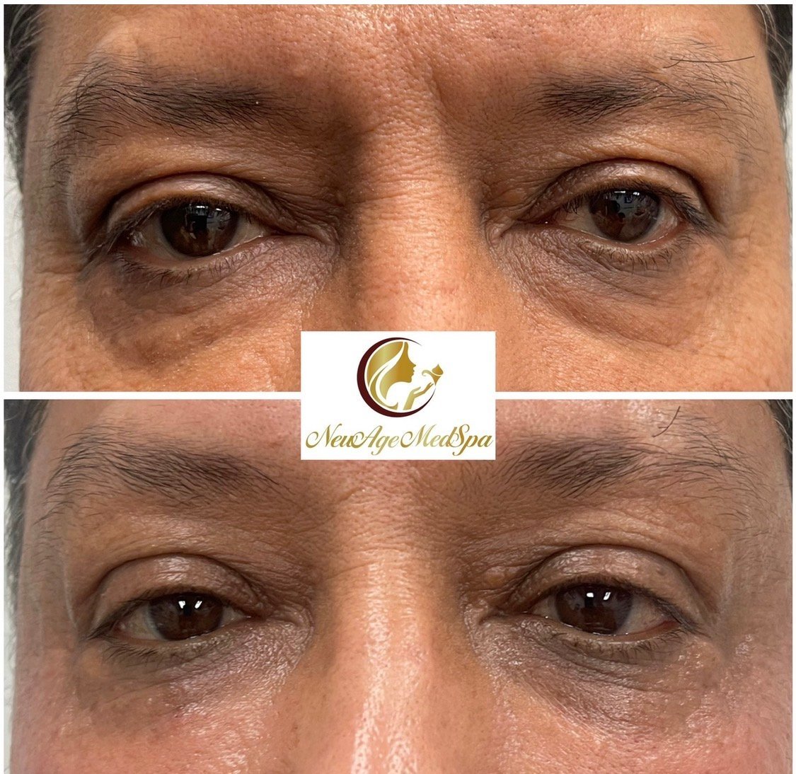 Antes y después: Rejuvenecimiento facial