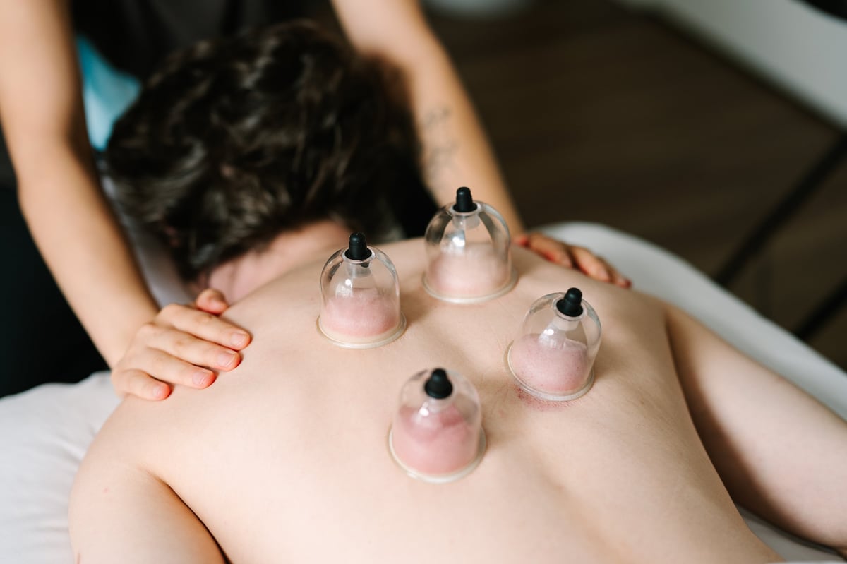 A person receiving cupping therapy treatment on their back with multiple glass cups creating suction marks on the skin