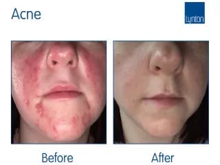 Before and after acne treatment comparison showing skin improvement on a patient's face
