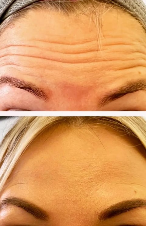 Before and after comparison of forehead showing reduced wrinkles and smoother skin texture