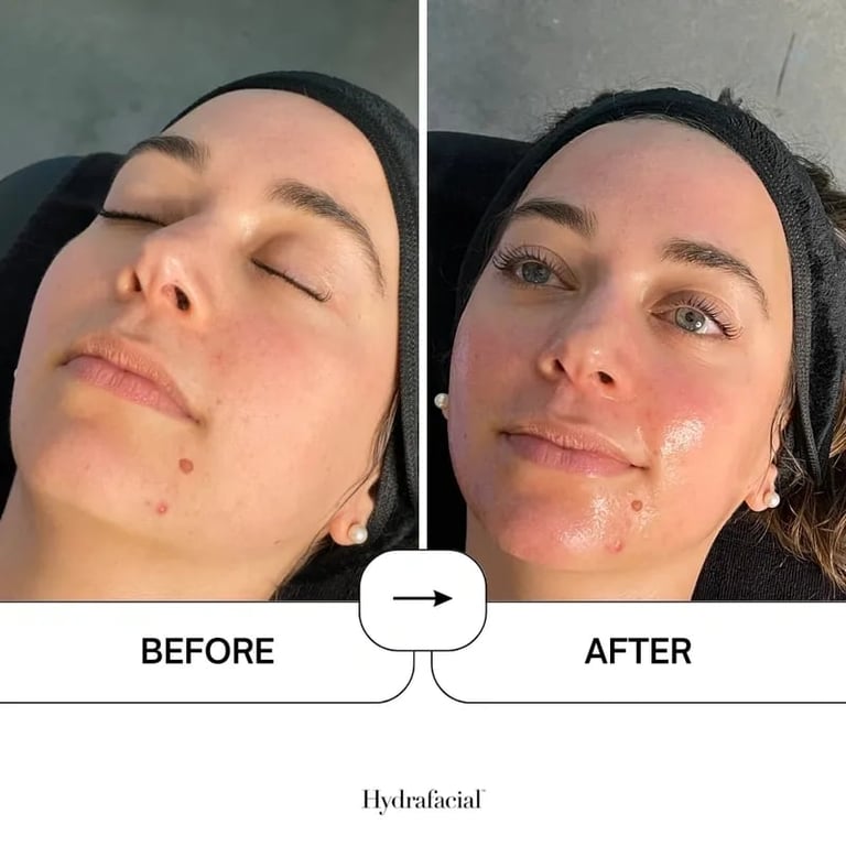 Before and after facial treatment comparison showing skin hydration improvement, labeled as Hydrafacial