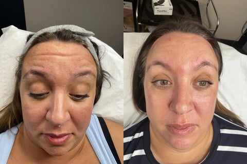 Before and after facial comparison photos showing a woman with closed eyes on left and open eyes looking forward on right.