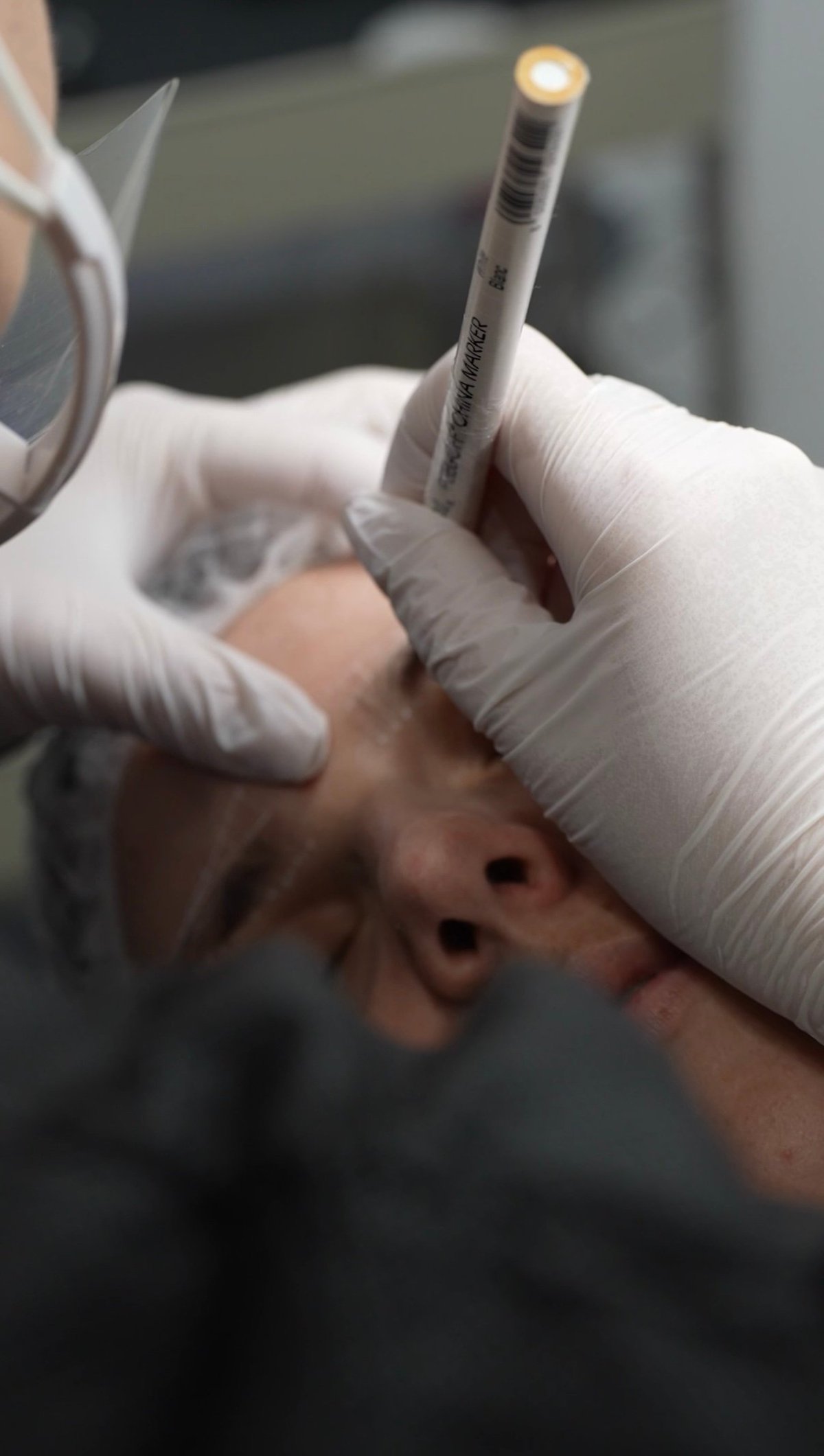 Healthcare professional in white gloves performing a skin examination or procedure on a patients face with a medical tool
